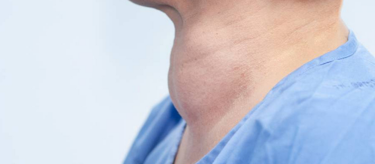 الإصابة بقصور الغدة