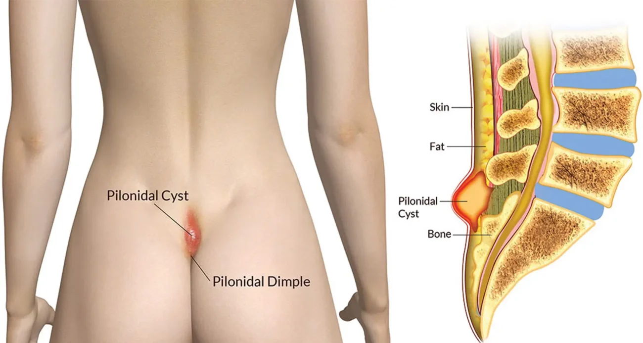 وجع العصعص وعلاجه | الأسباب وأحدث طرق العلاج الفعالة