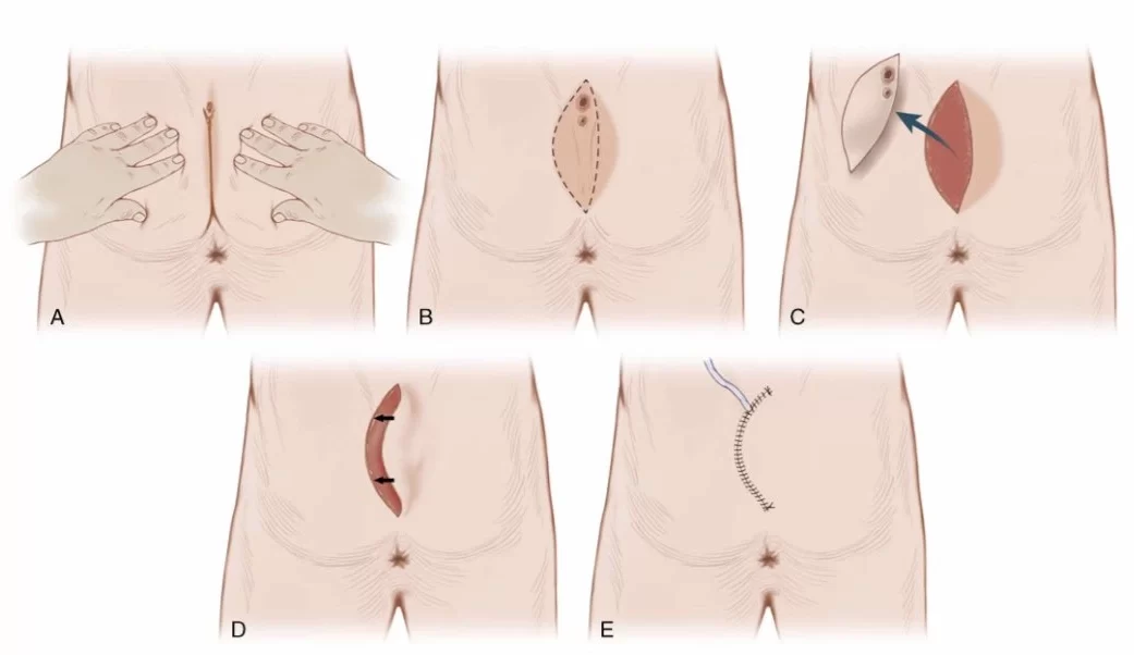 ألم العصعص وعلاجه | الأسباب وأحدث طرق العلاج الفعالة