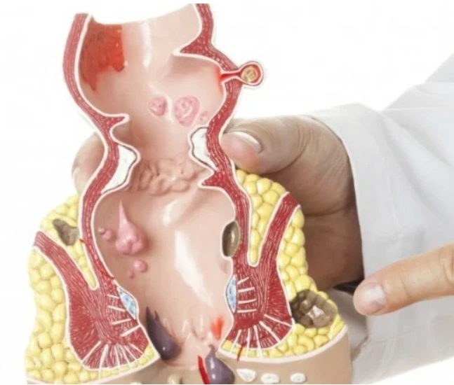 أعلاج البواسير بالليزر مصر