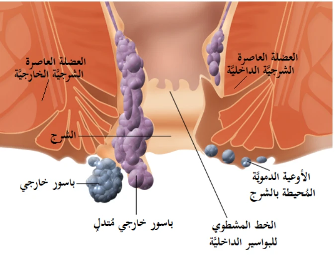 أفضل دكتور لعلاج البواسير بالليزر في مصر