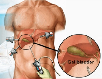 استئصال المرارة بالمنظار