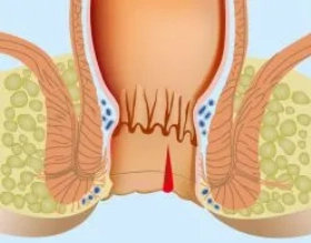  الشرخ الشرجي