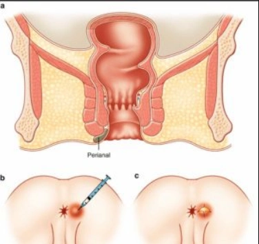 الخراج الشرجي