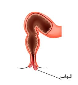سبب ظهور قطعة لحم في المؤخرة وعلاجها