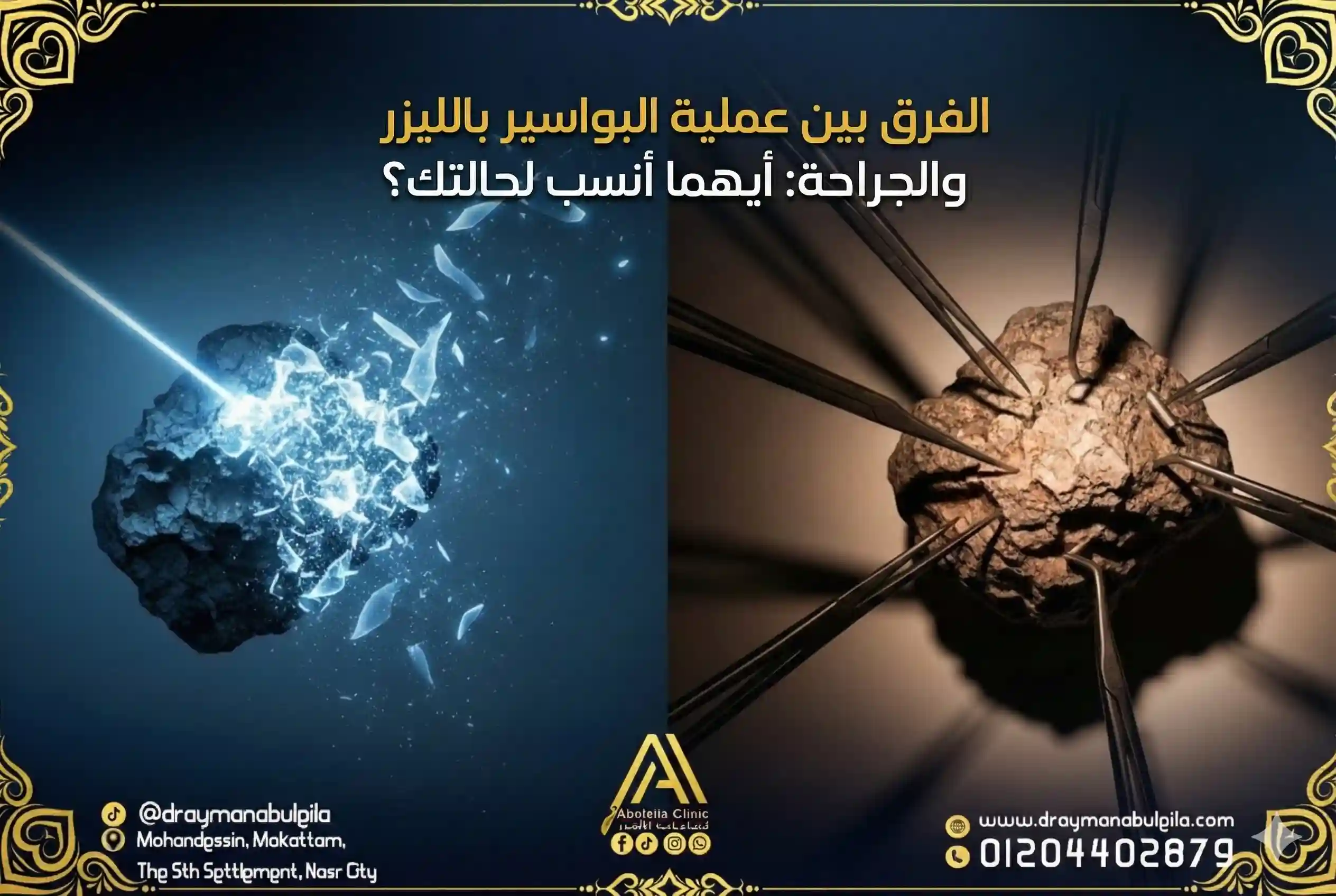  الفرق بين عملية البواسير بالليزر والجراحة أيهما أنسب لحالتك؟