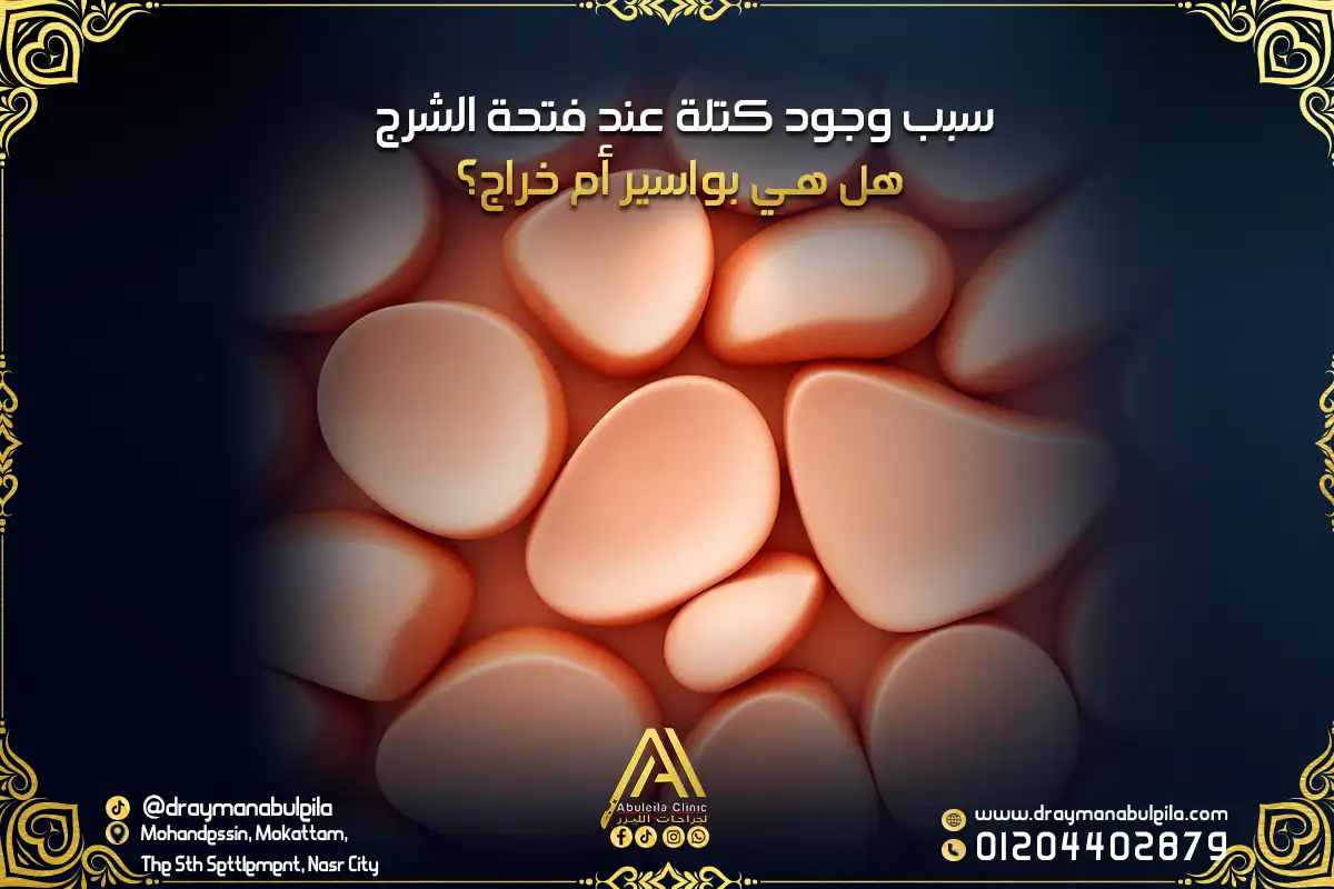 سبب وجود كتلة عند فتحة الشرج هل هي بواسير أم خراج؟