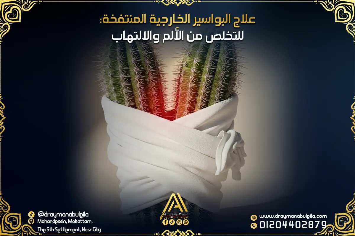 علاج البواسير الخارجية المنتفخة للتخلص من الألم والالتهاب