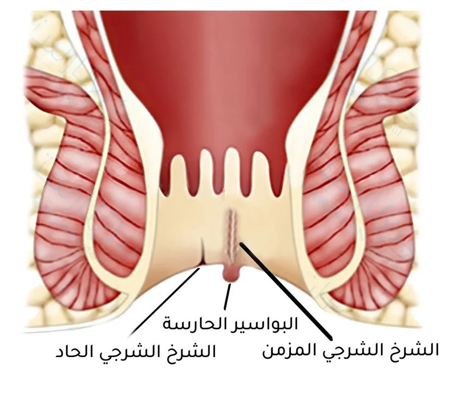 أفضل مرهم لعلاج الشرخ الشرجي