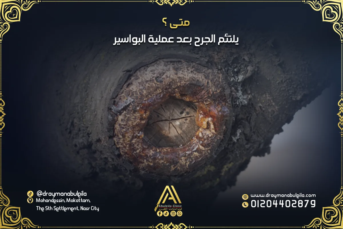 كم يستمر الألم بعد عملية البواسير