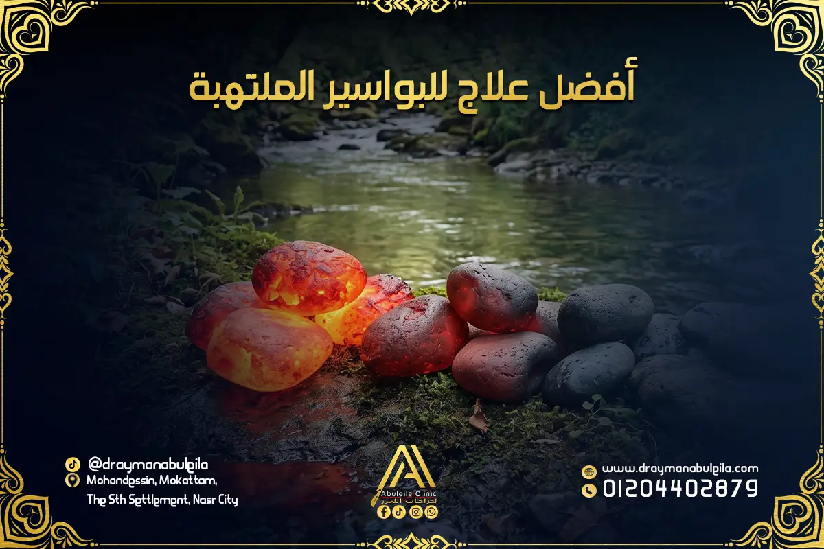 أفضل علاج للبواسير الملتهبة